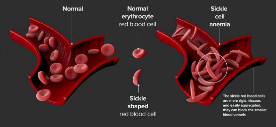 sickle_cell_disease_histology